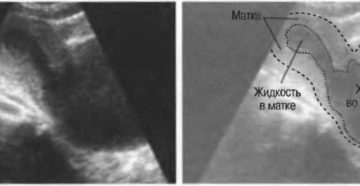 Скопление крови в матке