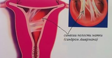 Срастание малых губ у девочек как выглядит