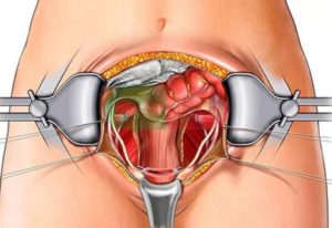 Как делают операцию по удалению матки