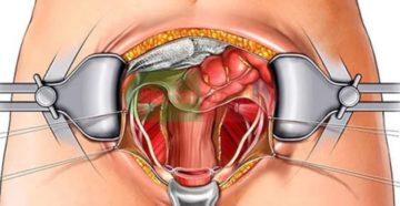 Как делают операцию по удалению матки