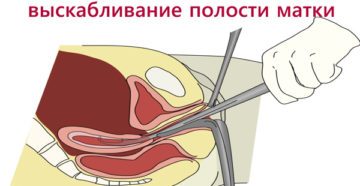 Чистка матки при кровотечении