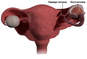 Перекрут ножки опухоли яичника