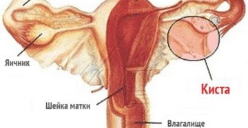 Опасна ли киста круглой связки на матке