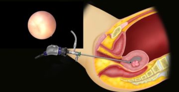 Гистерорезектоскопия полипа эндометрия что это такое