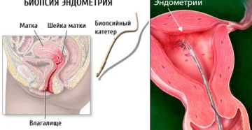 Аспирационная биопсия эндометрия что это такое