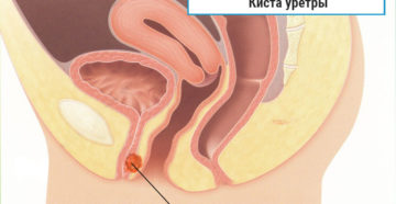 Киста уретры у женщин