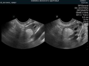 Фиброма правого и левого яичника