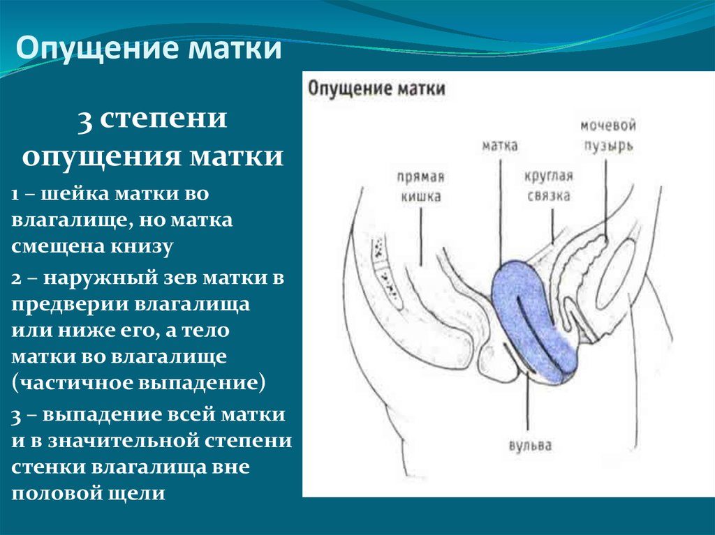 Причины опущения матки и лечение