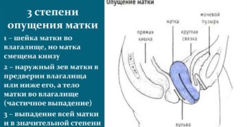 Причины опущения матки и лечение