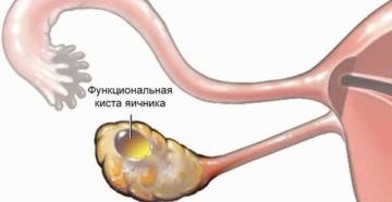 Температура при кисте яичника