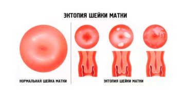 Эрозия шейки матки и эктропион