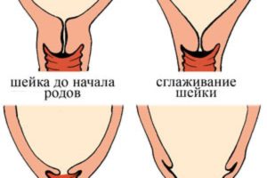 Как размягчить шейку матки в домашних условиях