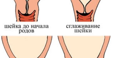 Как размягчить шейку матки в домашних условиях