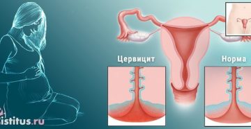 Цервицит при беременности