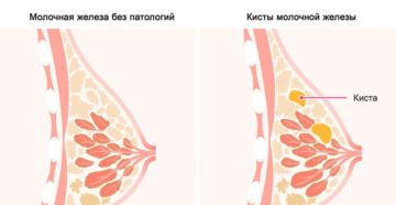 Диета при кисте молочной железы