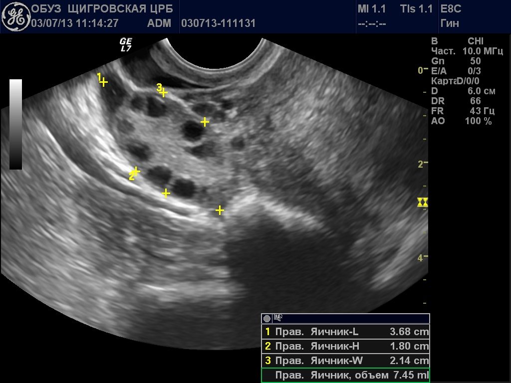 Почему на УЗИ не видно яичника