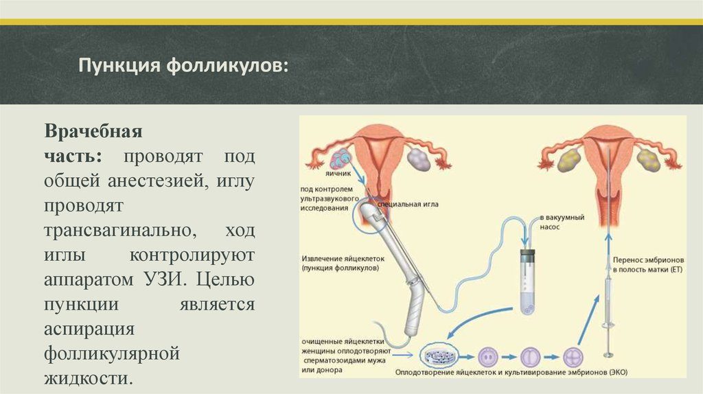 На какой день делают пункцию при ЭКО