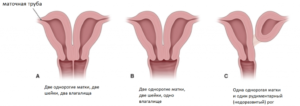 Две матки и две шейки матки