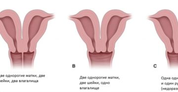 Две матки и две шейки матки