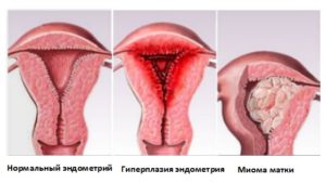 Почему не растёт эндометрий