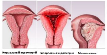 Почему не растёт эндометрий