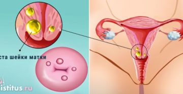 Киста в цервикальном канале шейки матки