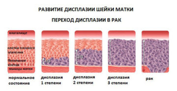 Дисплазия 1 степени шейки матки что это