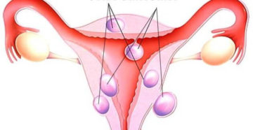 Фиброма и миома матки в чем отличие