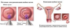 Электроконизация шейки матки при дисплазии