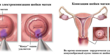 Электроконизация шейки матки при дисплазии