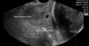 Можно ли увидеть на УЗИ эрозию шейки матки