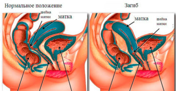 Причины, симптомы и лечение загиба шейки матки