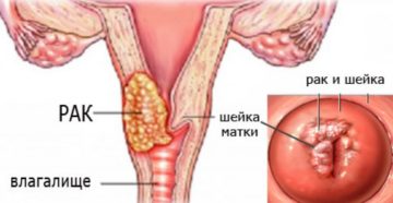 Карцинома шейки матки