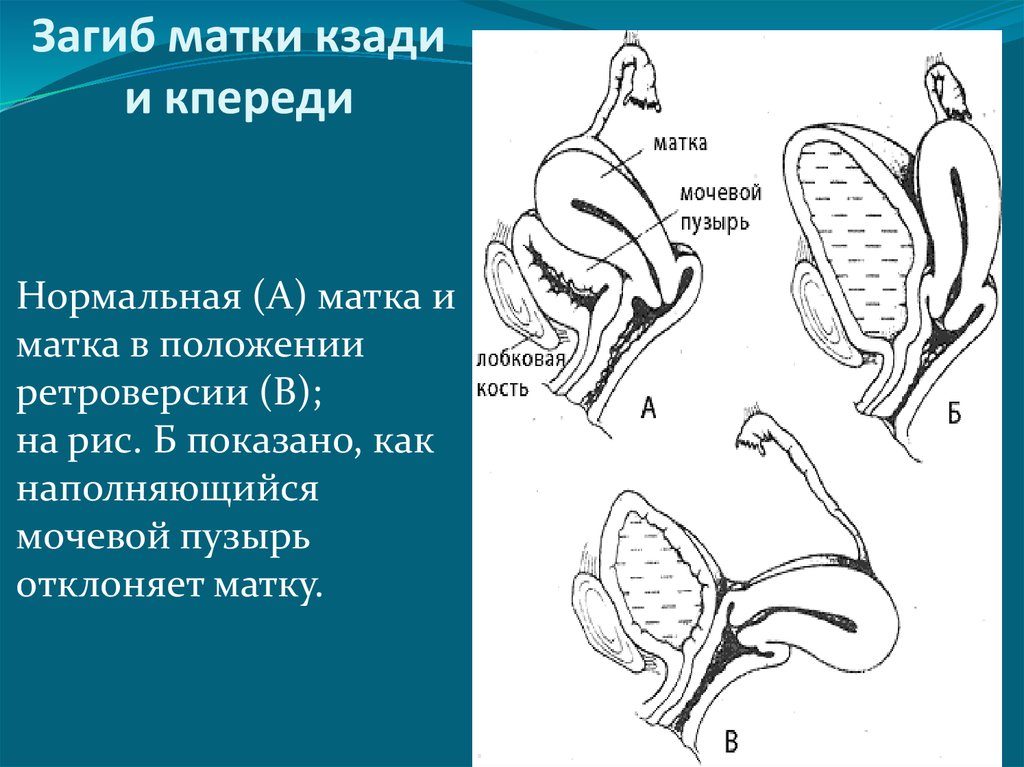 Причины возникновения загиба матки