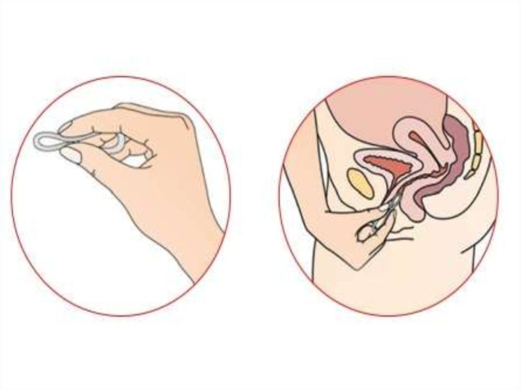 Кольцо противозачаточное для женщин