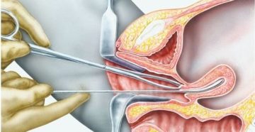 Зондирование полости матки алгоритм